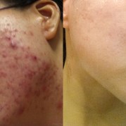 Before and after acne Photo